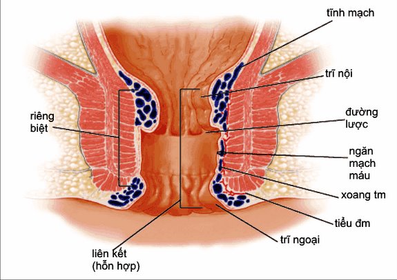 Nhận biết bệnh trĩ nội và trĩ ngoại