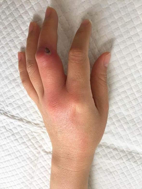 Bàn tay nữ bệnh nhân nhiễm trùng nặng do chủ quan với vết xướt