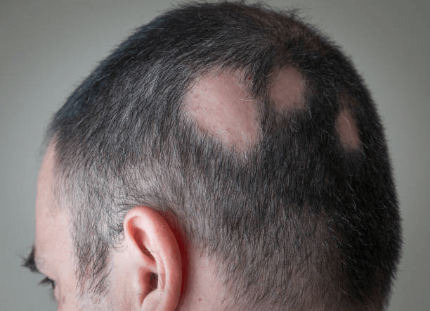 Rụng tóc từng mảng: Nguyên nhân và cách điều trị!