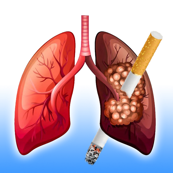 Cách nhận biết bệnh ung thư phổi cho người hút thuốc lá là gì?