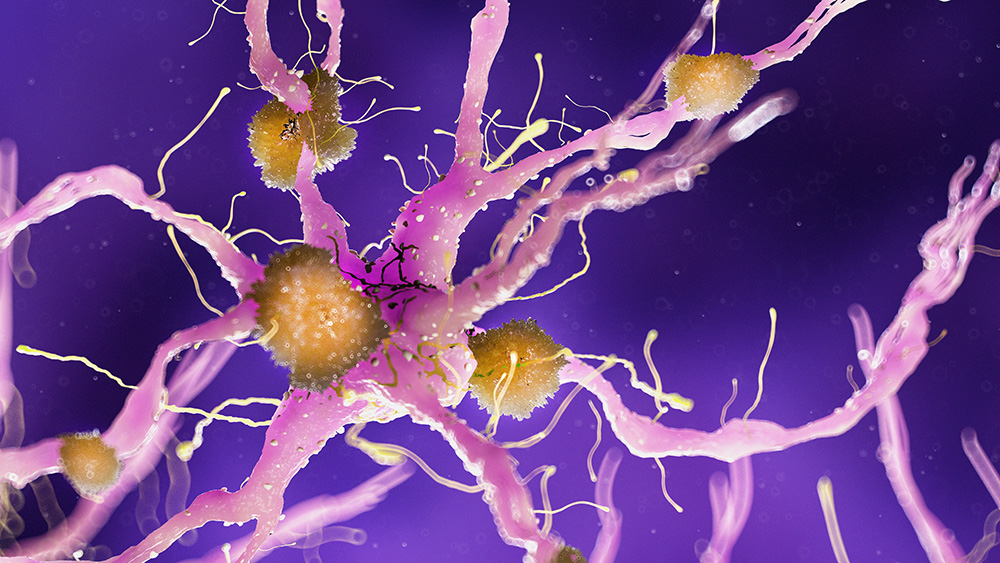 Các mảng amyloid beta tích tụ quanh tế bào thần kinh ở người bị mất ngủ