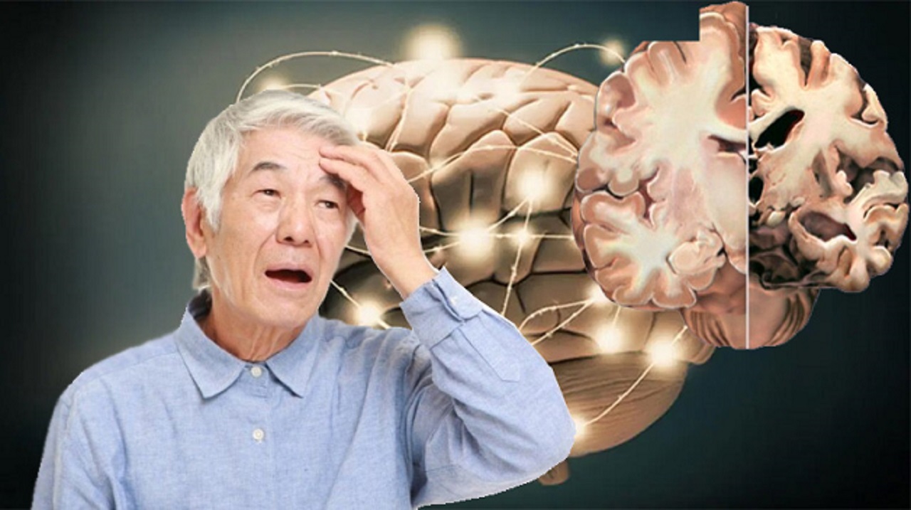 Mất ngủ sẽ làm tăng nguy cơ mắc Alzheimer