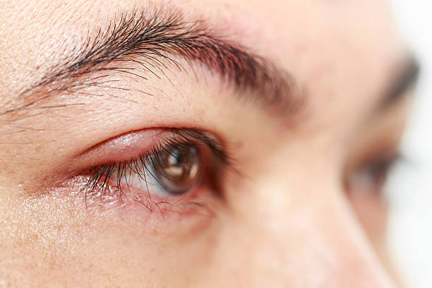 Viêm mí mắt: Nguyên nhân, triệu chứng, điều trị và phòng ngừa