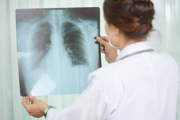 Cách chẩn đoán xác định bệnh lao phổi như thế nào?