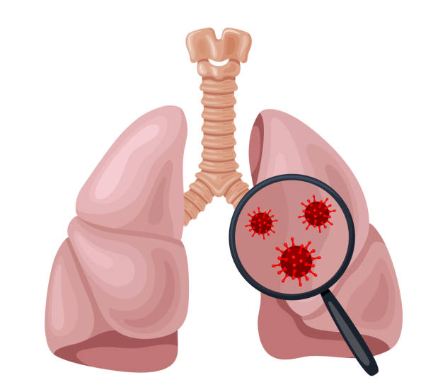  Cách điều trị bệnh lao phổi là gì?