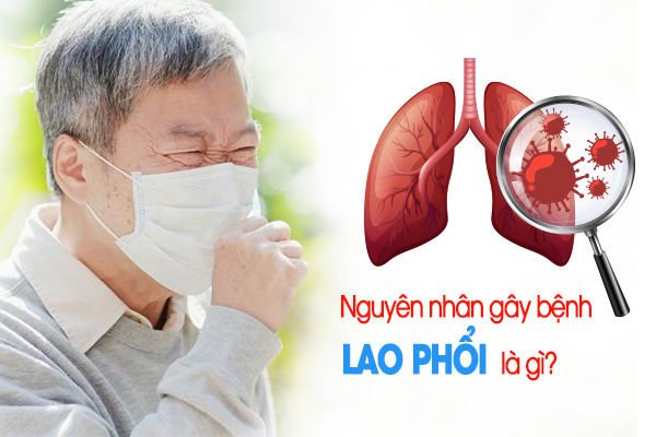 Nguyên nhân gây bệnh lao phổi là gì?