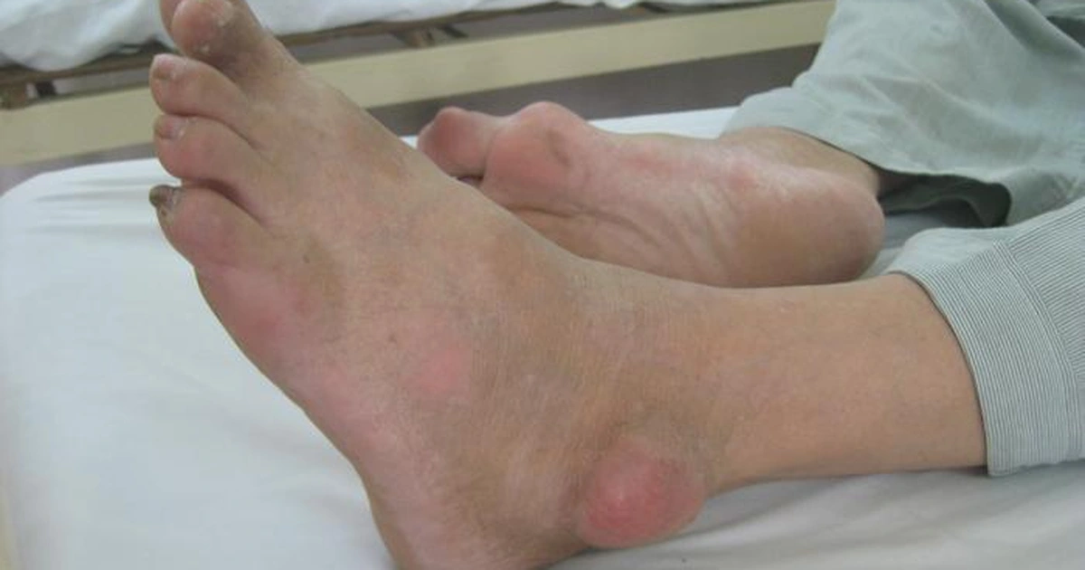 Bệnh gout gây đau gót chân do các tinh thể muối urat lắng đọng ở cổ khớp gót chân.