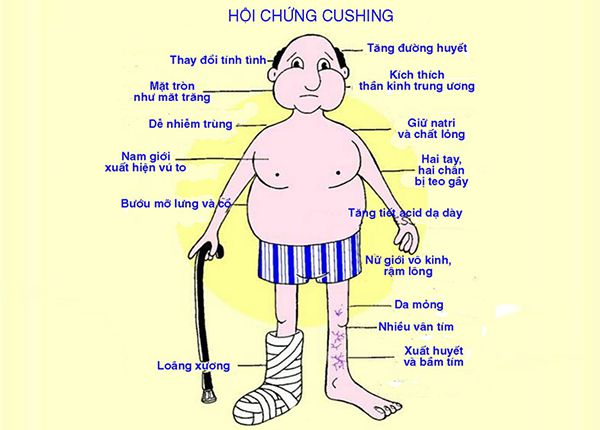  Một số triệu chứng của Hội chứng Cushing
