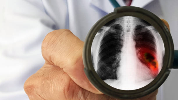 Ung thư phổi có triệu chứng dễ nhầm lẫn với các bệnh lý khác