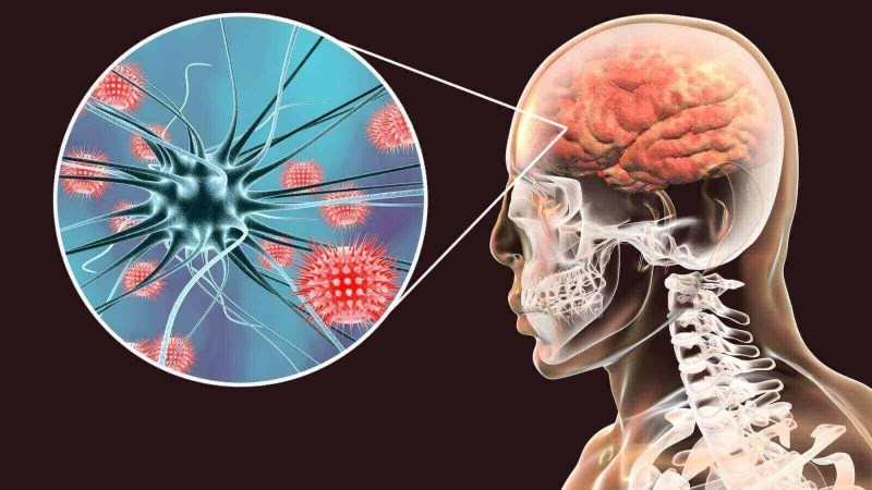 Viêm xoang có thể dẫn tới biến chứng viêm màng não.
