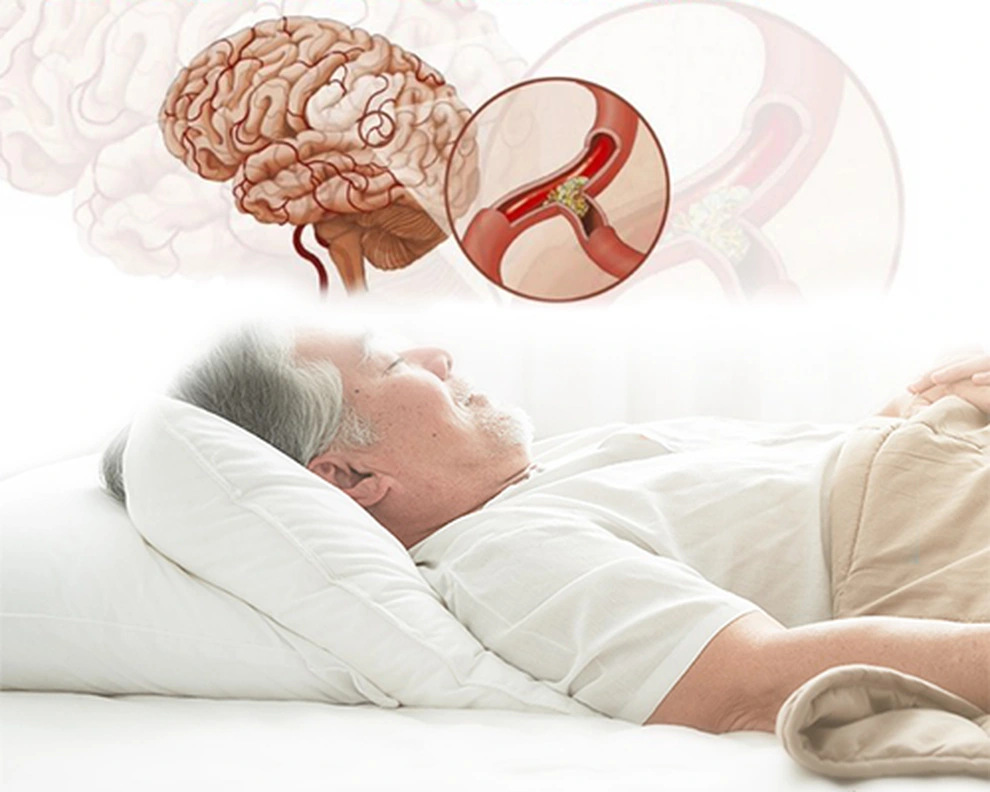 Hội chứng ngưng thở khi ngủ có thể làm tổn thương đến não bộ.