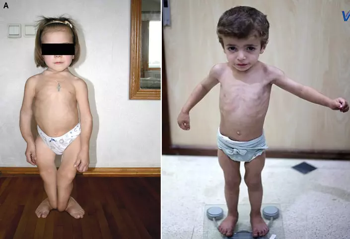Trẻ bị còi xương (trái) và trẻ bị suy dinh dưỡng (phải)