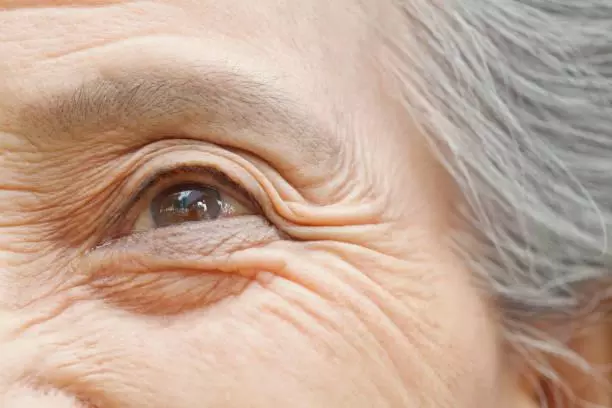 Những thay đổi ở mắt cảnh báo sớm bệnh Alzheimer