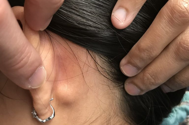 Nổi hạch sau tai có nguy hiểm không?