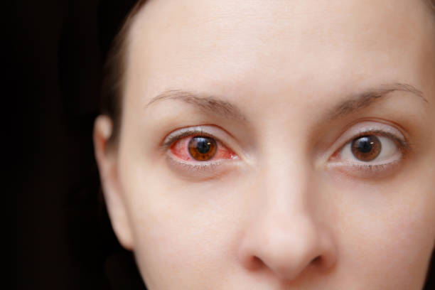 Viêm kết mạc là bệnh về mắt thường gặp ở cả người lớn và trẻ em