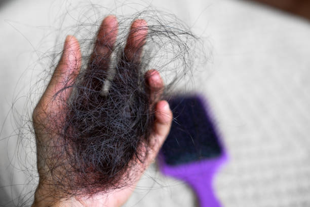 Rụng tóc nhiều là bệnh gì?