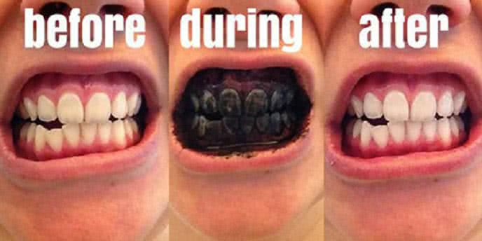 Đánh răng với than hoạt tính có thể làm răng trắng hơn