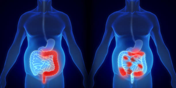 Bệnh viêm loét đại tràng và bệnh Crohn có nhiều triệu chứng giống nhau