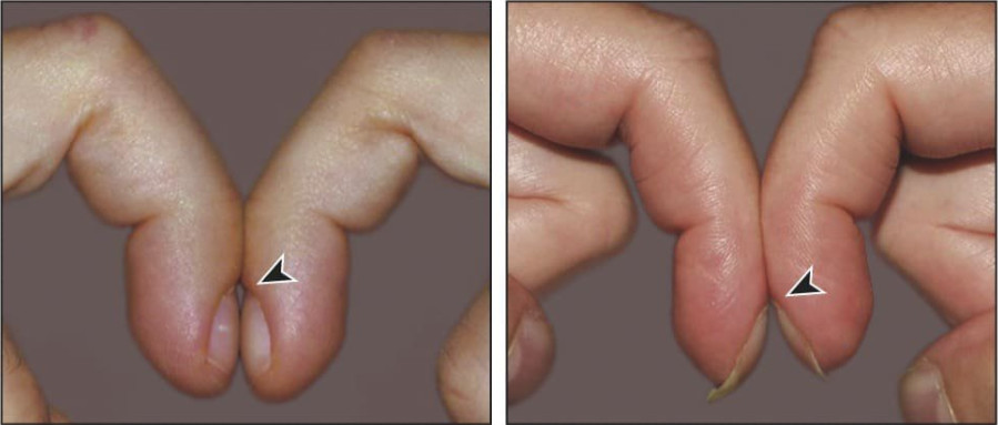  Ngón tay bình thường (trái) và ngón tay dùi trống (phải)