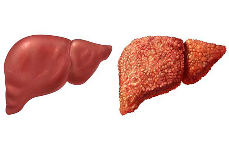  Hình ảnh gan bình thường (trái) và gan bị xơ (bên phải)