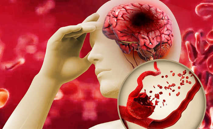Mạch máu trong não bị vỡ gây đột quỵ xuất huyết não