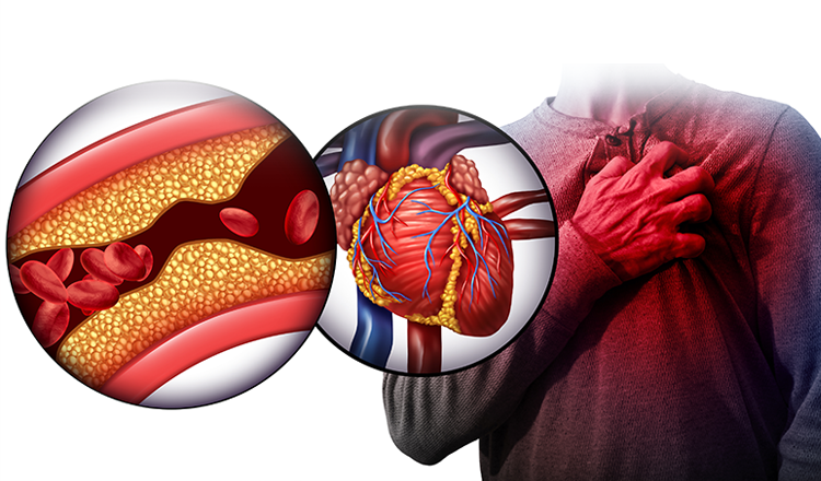 Mỡ máu làm tăng nguy cơ nhồi máu cơ tim