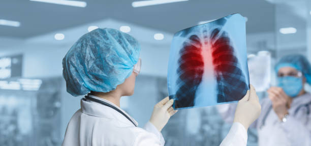 Phế cầu có thể gây ra viêm phổi