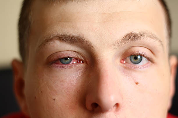 Những điều cần biết về bệnh đau mắt đỏ và cách phòng ngừa