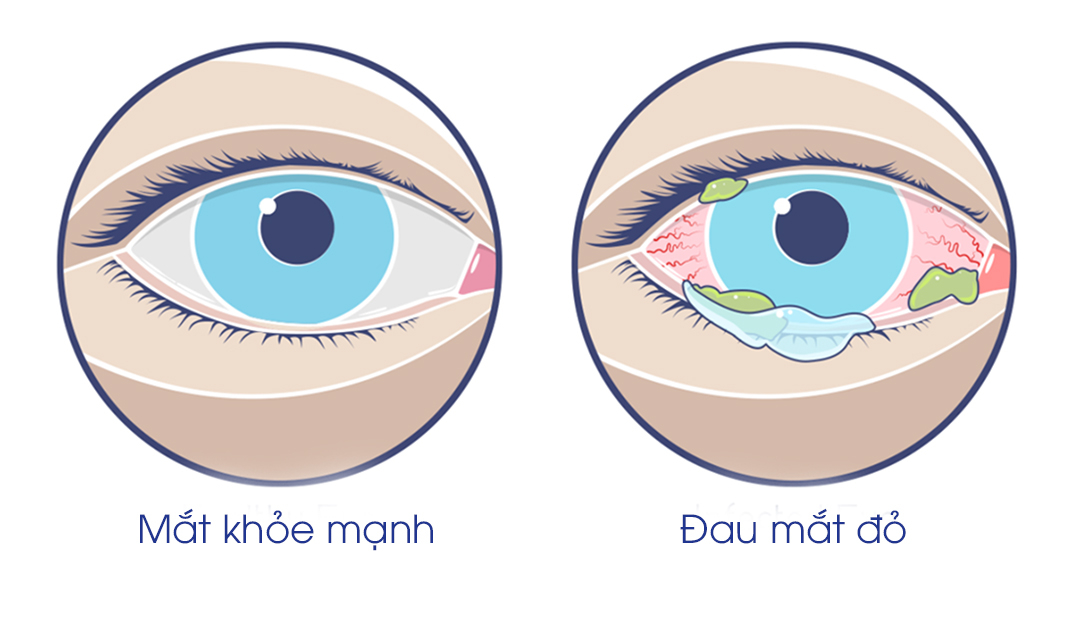  Minh họa mắt khỏe mạnh và mắt ở bệnh nhân đau mắt đỏ.
