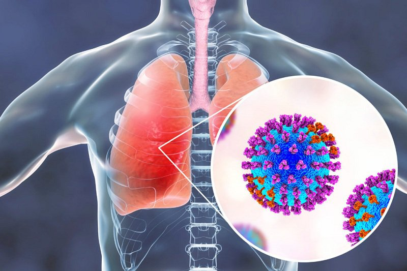 Phế cầu khuẩn vào mùa, người dân cần chủ động tiêm chủng ngừa viêm phổi
