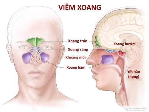  Xoang bị viêm ở vùng nào thì cảm giác đau nhức sẽ xuất hiện ở vùng đó.