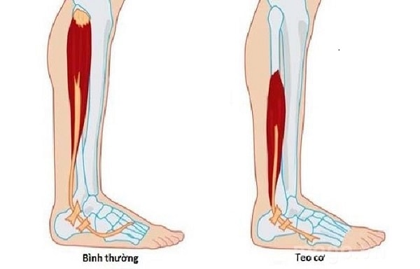 Minh họa tình trạng teo cơ.