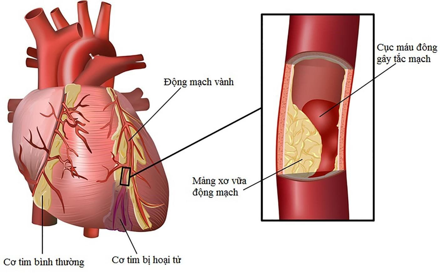 Nhiệt độ giảm dễ tạo thành cục máu đông gây tắc mạch.