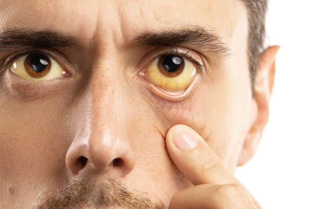 Vàng da, vàng mắt là dấu hiệu của bệnh về gan