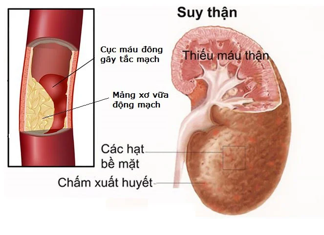 Tăng huyết áp làm tổn thương thận.