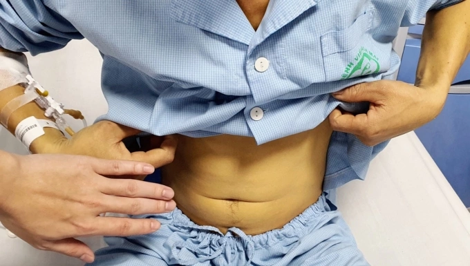 Nuốt mật cá trắm để tăng sinh lực: Nguy cơ suy thận, tổn thương gan